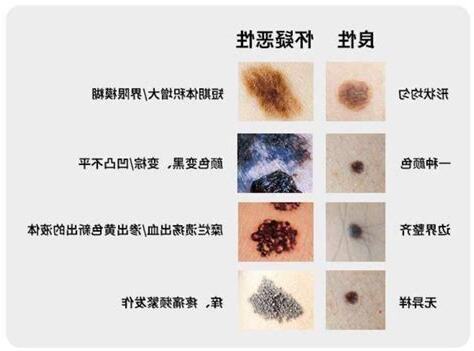 痣 癌变